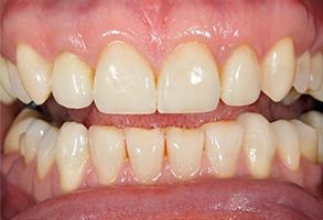 Mark Studer, DDS  | Fluoride Treatment, Laser Dentistry and Oral Exams
