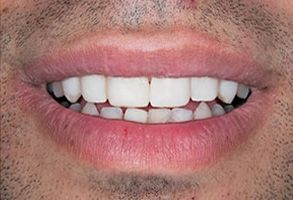 Mark Studer, DDS  | Dental Lab, Sports Mouthguards and Oral Exams