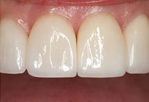 Mark Studer, DDS  | Teeth Whitening, Laser Dentistry and TMJ Disorders