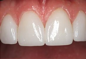 Mark Studer, DDS  | Sports Mouthguards, Teeth Whitening and Fluoride Treatment