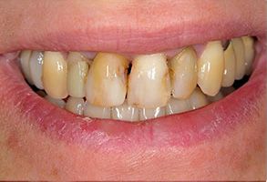 Mark Studer, DDS  | Fluoride Treatment, Snoring Appliances and Teeth Whitening