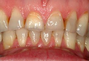 Mark Studer, DDS  | Fluoride Treatment, Preventative Program and Teeth Whitening